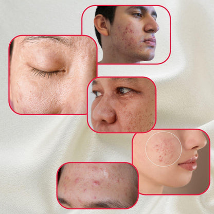 Gymsegbë - Perfect Trifecta Acne Peel
