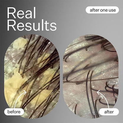 Act+Acre Salicylic Acid Scalp Exfoliator Serum